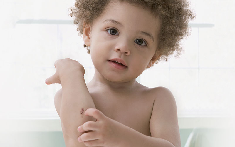 KELOCOTE® Scar Treatment How Scarring Affects Children