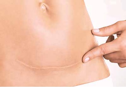 KELO-COTE® is effective on c-section scars